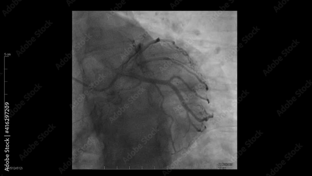 Xray images of blood pumping through the veins during a cardiac
