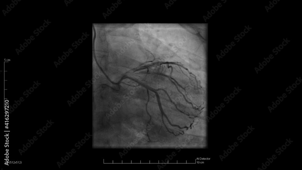Xray images of blood pumping through the veins during a cardiac