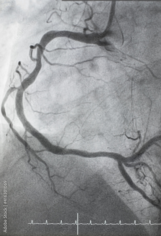 Coronary angiogram , medical x-ray for heart disease. Coronary artery ...