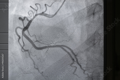 Coronary angiogram , medical x-ray for heart disease. Coronary artery disease.