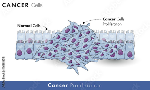 
Cancer cell proliferation in healthy tissue or healthy cells with labelling. Abnormal growth of normal cells in human body vector graphic illustration