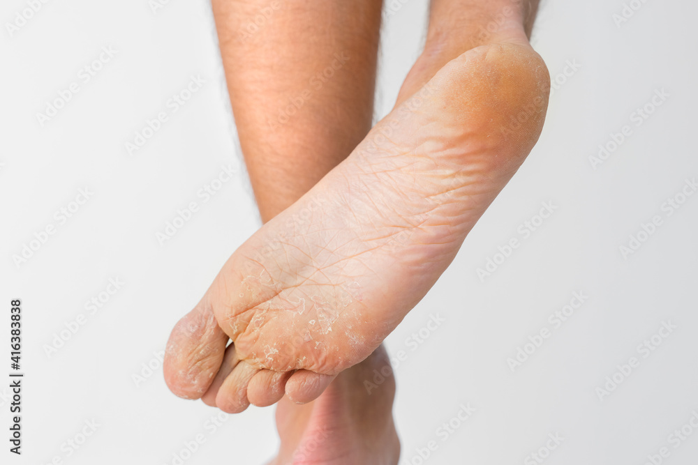 Close up of dry feet. Peeling and cracked foot. Fungal infection or athlete's foot, dry skin, dermatitis, eczema, psoriasis, sweaty feet or dehydration. Health care concept Close up of dry feet. Peeling and cracked foot. Fungal infection or athlete's foot, dry skin, dermatitis, eczema, psoriasis, sweaty feet or dehydration. Health care concept