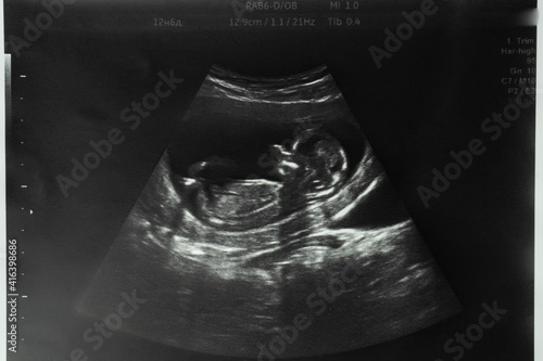 Image of mother's womb ultrasound during pregnancy. Ultrasound of a fetus at 12 weeks 6 days.