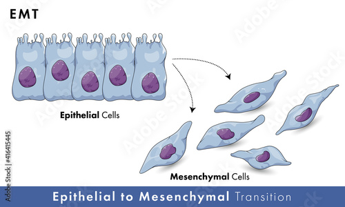 Epithelial to mesenchymal Transition or EMT mechanism in Cancer cell formation or malignant tumor formation vector concept