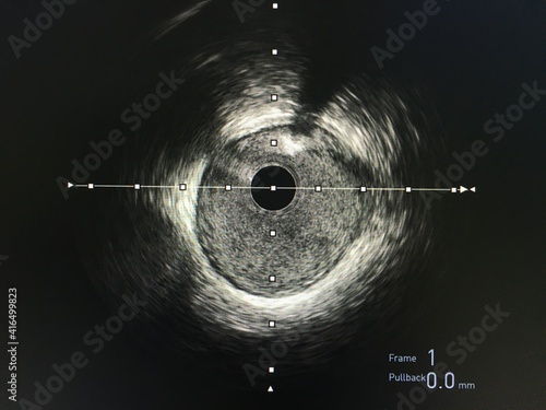 Konstfotografi Intravascular ultrasound imaging (IVUS) at cardiac catheterization laboratory room