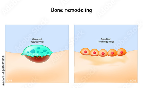 Bone remodeling photo