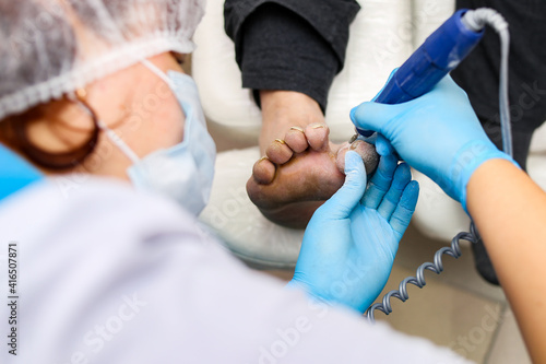Disease thickening of the toenail  cutting off the excess layer with a pedicure apparatus.