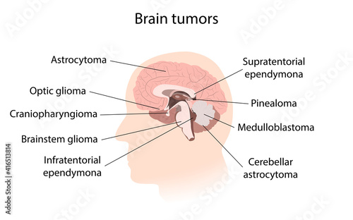 Brain cancer, tumor with explanations. Sihuette of man head, inner view.