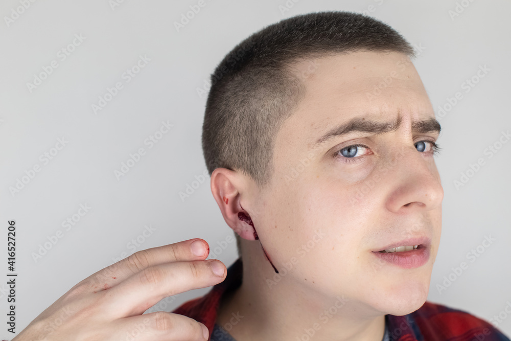 A man whose ear is bleeding. Vascular rupture, damage to the tympanic membrane, ear diseases, oncology, otitis media, myringitis A man whose ear is bleeding. Vascular rupture, damage to the tympanic membrane, ear diseases, oncology, otitis media, myringitis