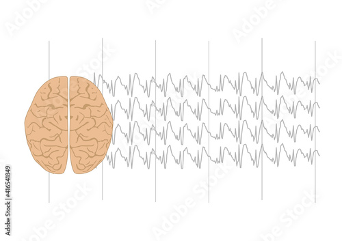 Illustration of brain and genearlized sharp waves