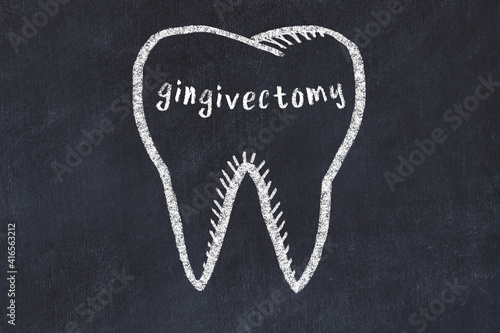 Chalk drawing of a tooth with medical term gingivectomy. Concept of learning stomatology photo