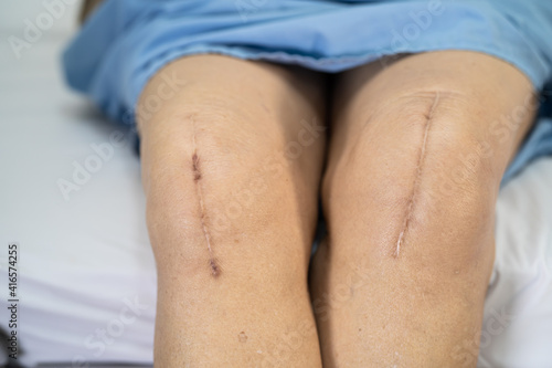 Asian senior or elderly old lady woman patient show her scars surgical total knee joint replacement Suture wound surgery arthroplasty on bed in nursing hospital ward, healthy strong medical concept. © amazing studio