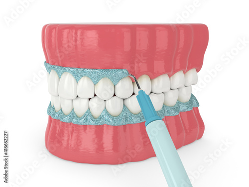 Billede på lærred 3d render of jaw with gingival mask before teeth bleaching