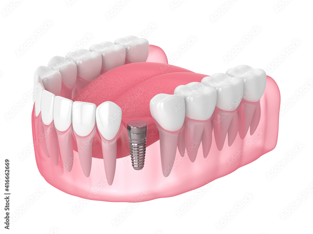 Obraz premium 3d render of jaw with implant screw and buried healing cap under gums