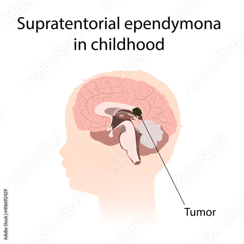 Supratentorial ependymona in childhood. Brain cancer, tumor with explanations.