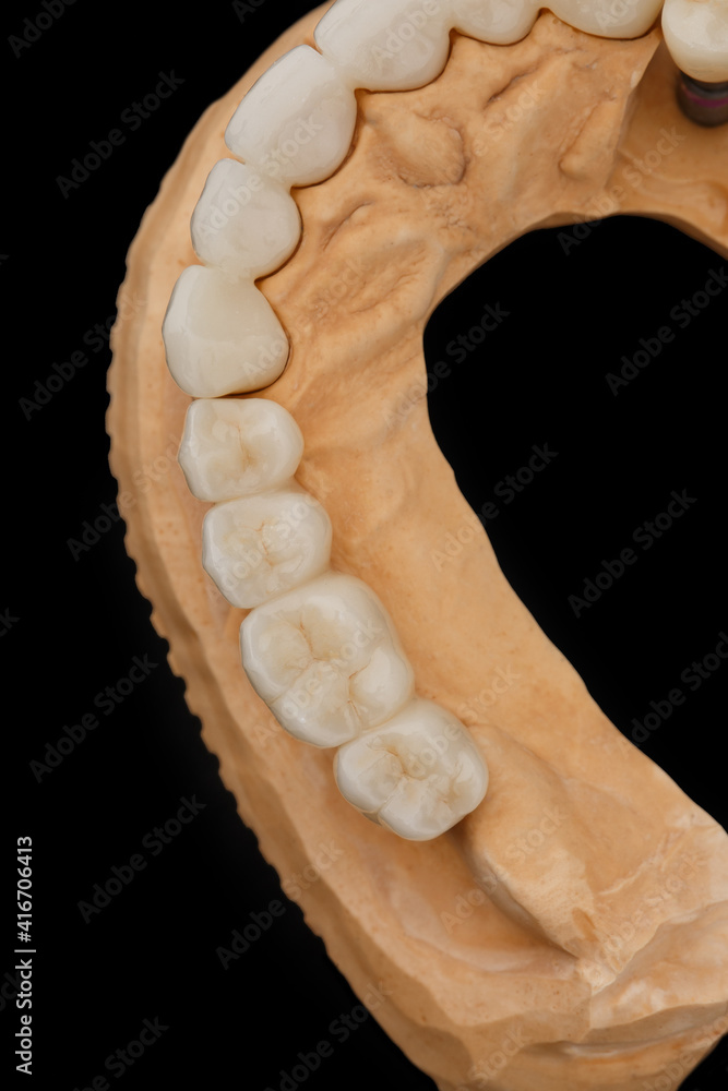 Close-up top view photo of a dental jaw prosthesis on black glass background. Artificial jaw with veneers and crowns. Tooth recovery with implant. Dentistry conceptual photo. Prosthetic dentistry.