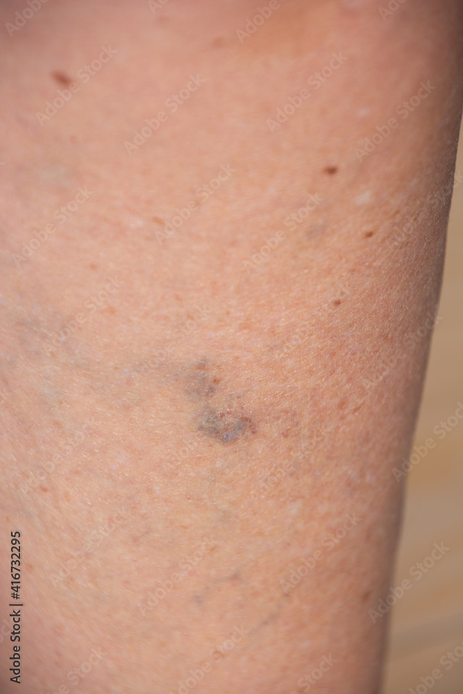 red and blue varicose and spider veins on womans leg Concept for medicine and cosmetology red and blue varicose and spider veins on womans leg Concept for medicine and cosmetology
