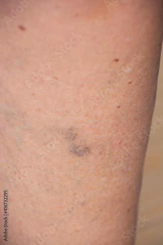 red and blue varicose and spider veins on womans leg Concept for medicine and cosmetology