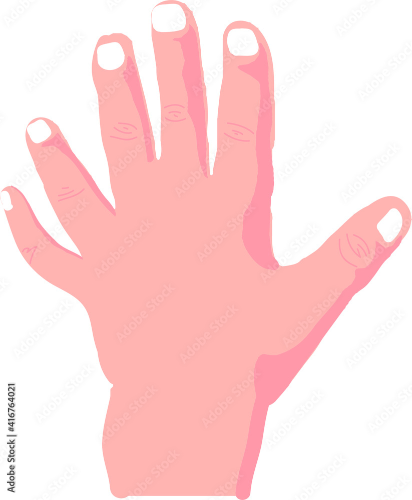 Vector Illustration of Hexadactyly, Six Fingered Vector Illustration of Hexadactyly, Six Fingered