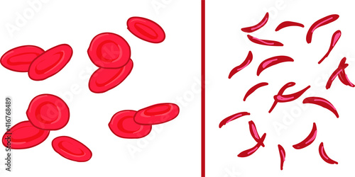 Vector Illustration of Sickle Cell Anemia, Health