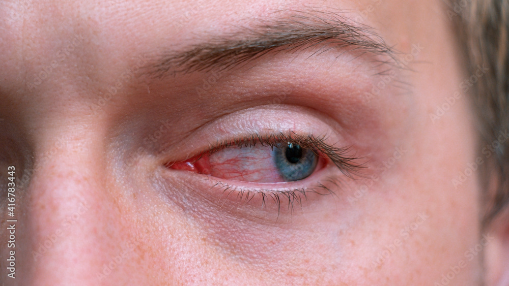 Close up irritated infected red bloodshot eyes. Conjunctivitis