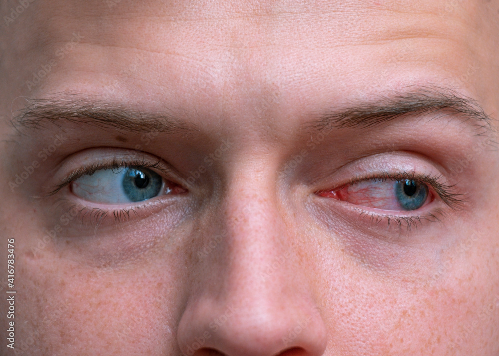 Naklejka premium Close up irritated infected red bloodshot eyes. Conjunctivitis. Inflammation of the eyes. Mens red eye close-up, fatigue, problems with blood vessels. Red eye for irritation of the sclera