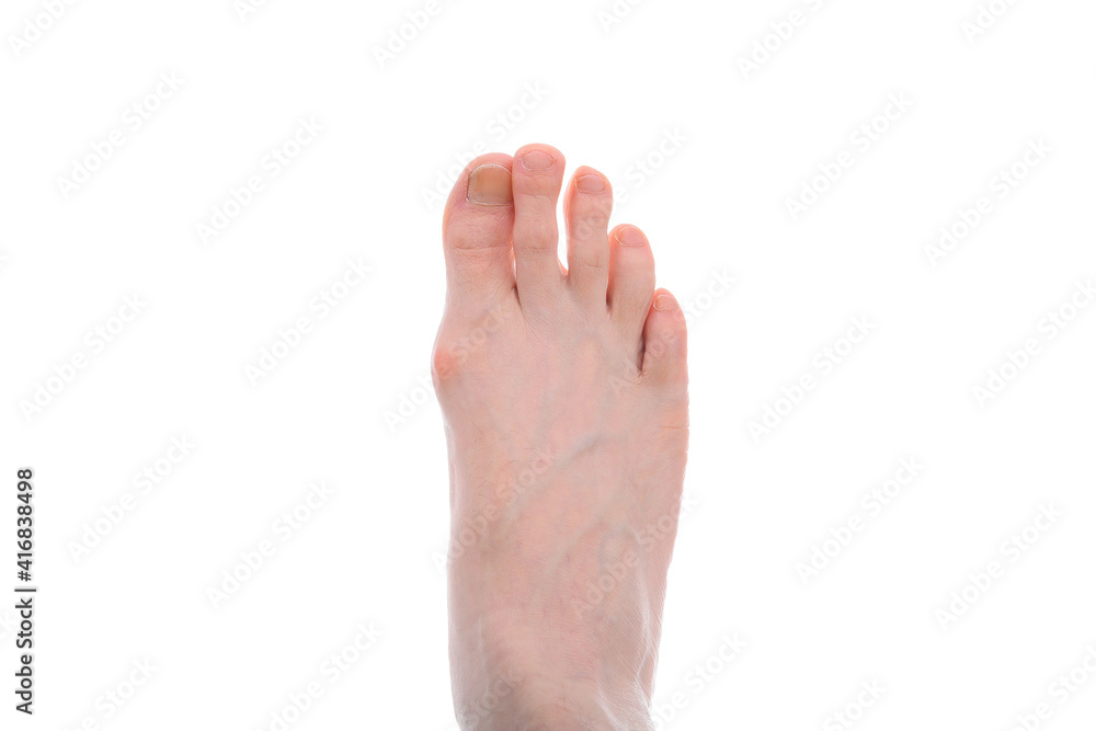 The onset of degenerative disease on the leg due to poor footwear in a man The onset of degenerative disease on the leg due to poor footwear in a man