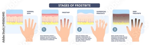 Frostbite treat toes cold ice improperly icing injury burn skin tissue white yellow black frozen Pain Numbness Tingling snow blistered loss muscle freeze first aid raynaud deep prevent
