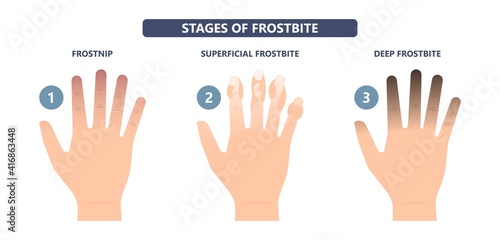 Frostbite treat toes cold ice improperly icing injury burn skin tissue white yellow black frozen Pain Numbness Tingling snow blistered loss muscle freeze first aid raynaud deep prevent