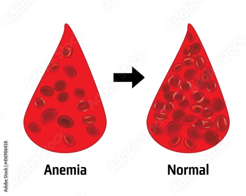 Anemia and normal ammount of red blood cells