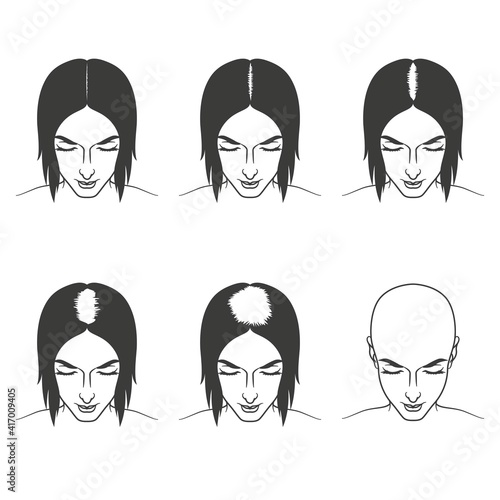 Stages of female hair loss, treatment and hair care