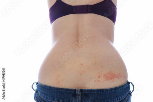 Εκτύπωση καμβά Woman with scabies on her back caused from mites burrowing in the skin