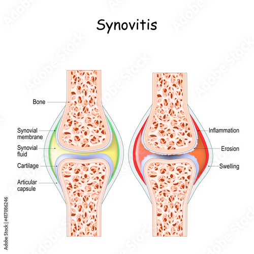 synovitis. Close-up photo