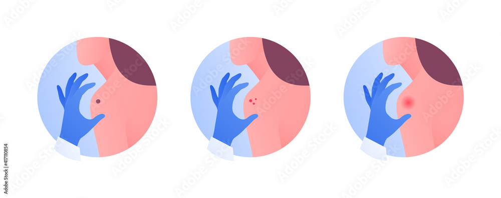 Dermatology and skin health care concept. Vector flat color illustration icon set. Dermatologist doctor hand in protective gloves touch female patient. Acne, melanoma cancer, allergy mole symbol.