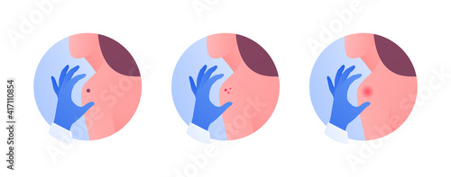 Dermatology and skin health care concept. Vector flat color illustration icon set. Dermatologist doctor hand in protective gloves touch female patient. Acne, melanoma cancer, allergy mole symbol.