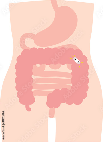 カプセル型　大腸カメラ　検査　