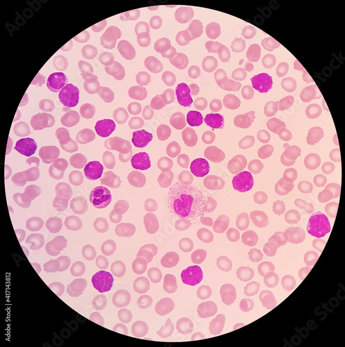 Leukocytosis of human peripheral blood smears. Blast and neutrophil on red blood cells background in patient with leukemia.