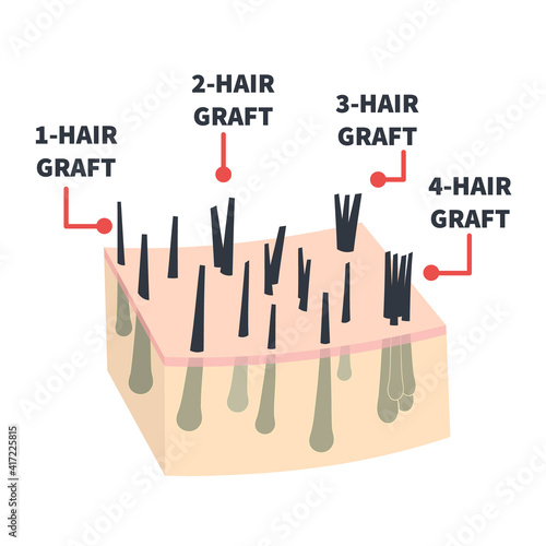 Hair micrograft classification set for hair transplantation surgery. Skin cross-section with number of hairs in the follicular unit or family. Hair science and anatomy. Cartoon vector illustration.