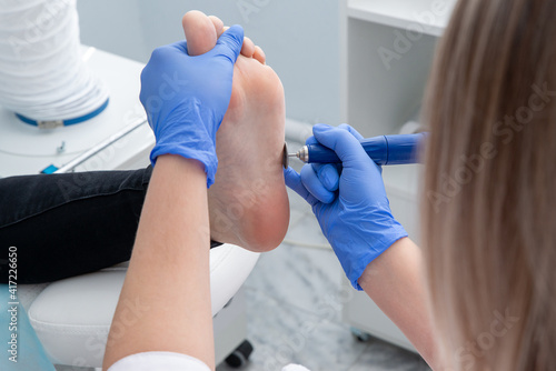 Chiropodists removes dry skin at the heel of the foot of a woman