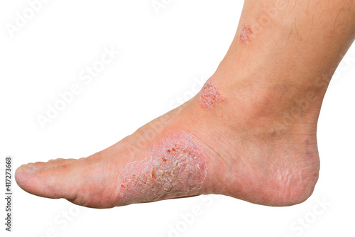 Wounds and dry skin on human foot. Ulcers and infection of medical concepts. photo