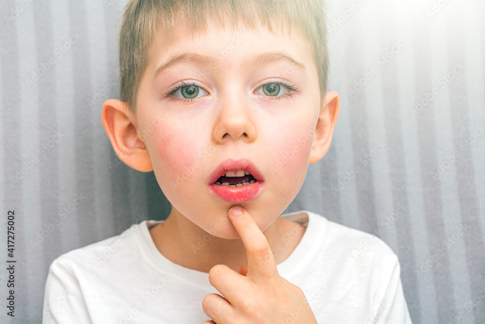 Child loose tooth. Little boy 6 years old loose baby tooth incisor. Kids dental medicine and oral hygiene concept. Emotions of child. Close up portrait. Child loose tooth. Little boy 6 years old loose baby tooth incisor. Kids dental medicine and oral hygiene concept. Emotions of child. Close up portrait.