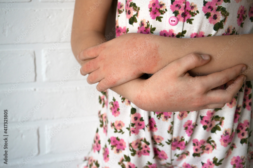 Hands of a little girl with contact dermatitis, Concept with Healthcare And Medicine. Contact dermatitis, skin effects. Health. soft focus Hands of a little girl with contact dermatitis, Concept with Healthcare And Medicine. Contact dermatitis, skin effects. Health. soft focus