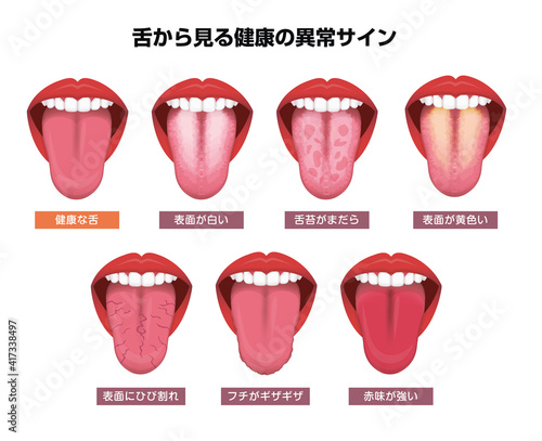 舌（べろ）が表す体の不調シグナル　ベクターイラストセット
