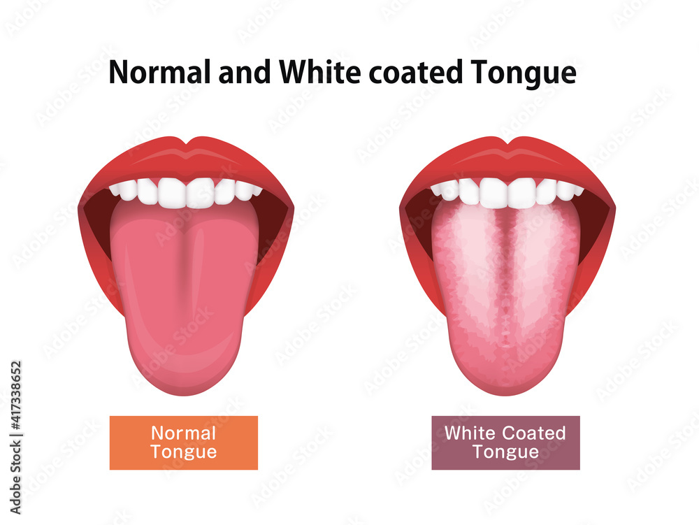 Tongue’s health sign vector illustration ( White coated tongue )