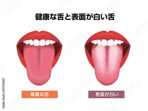 舌（べろ）が表す体の不調シグナル / 健康な舌と白い舌苔
