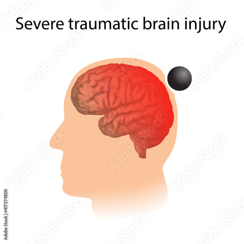 TBI. Severe traumatic brain injury. Head damage.