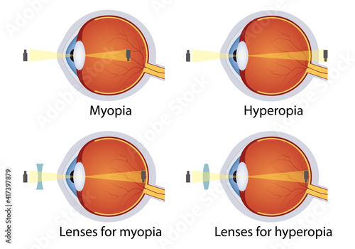 Hyperopia and myopia corrected by lens. Concept of eyes defect. Correction of various eye vision disorders by lens. photo