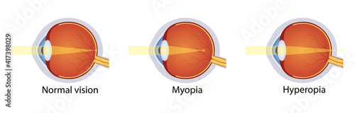 Normal vision, hyperopia, myopia. Set of vision disorders. Anatomy of eyeball defect. Vector illustration