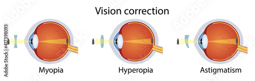 Correction of various eye vision disorders by lens. Hyperopia, myopia, astigmatism. Vector illustration