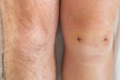 Canvas Print Close-up of a surgical suture on the knee after laparoscopic minisk surgery